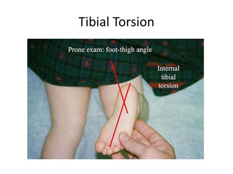 tibial torsion test|femoral anteversion and tibial torsion.